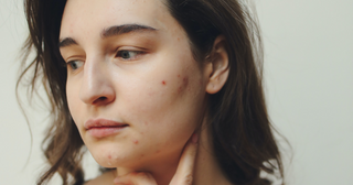Do You Have Unknown Rashes Appearing Around Your Mouth? It Might Be The Perioral Dermatitis