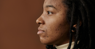 What Does Symmetrical Acne Mean? Causes, Hormones & How To Treat In 2026.