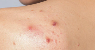 Why Are You Suddenly Getting Body Acne? Causes and How to Treat It