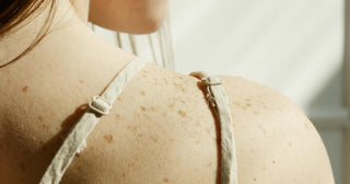 What’s The Cause of Back Acne and How to Treat It?