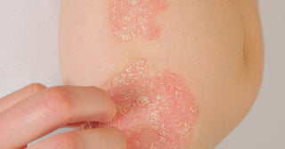 Is the Sun Good for Psoriasis?  Causes, Triggers & How To Treat Flare-Ups in Summer 2026