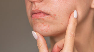 Is Your Skin Barrier Damaged? How It Triggers Flare-Ups, Signs and What to Do About It