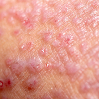Eczema prone skin close up