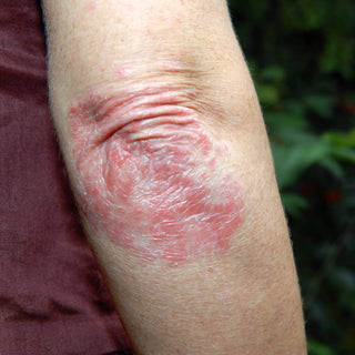 Eczema on elbow