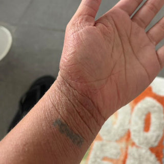 Eczema on hand before Dead Sea Dream products